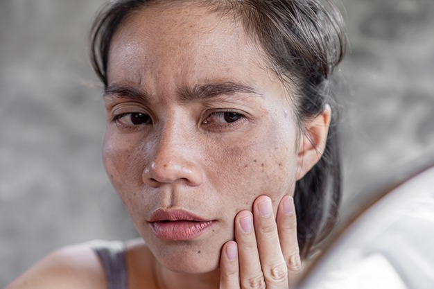 gMelasma: What are the Best Treatments?