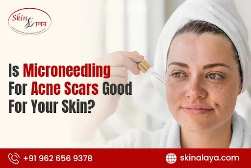 Is microneedling for acne scars good for your skin?