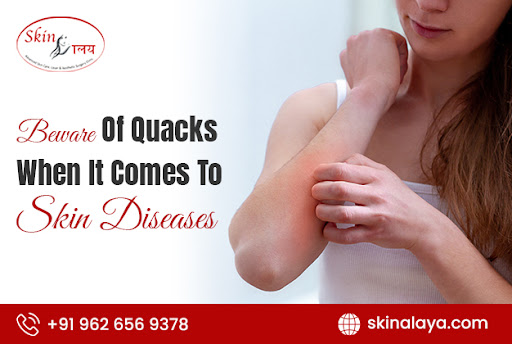 Beware Of Quacks When It Comes To Skin Diseases